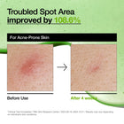 Anua Azelaic Acid 10+ Hyaluron Soothing Serum - 30ml