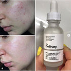 The ordinary نياسيناميد 10% زنك1% - solution