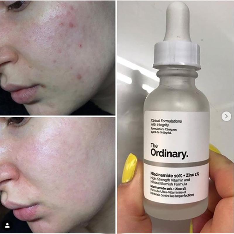 The ordinary نياسيناميد 10% زنك1% - solution